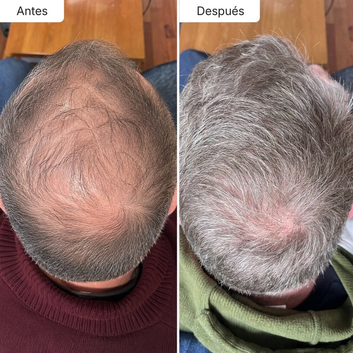 Sérum Anticaída de Doble Acción | Hair Biolabs™